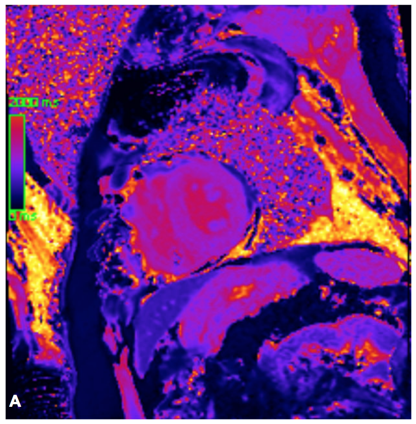🧲Cardiovascular magnetic resonance for suspected cardiac amyloidosis: where are we now? <a href="/almallahmo/">Mouaz Al-Mallah, M.D MSc</a> <a href="/MaanMalahfji/">Maan Malahfji</a> <a href="/yushui_han/">Yushui Han</a> <a href="/drAhmedIA/">Ahmed Ibrahim Ahmed, MD MPH</a> <a href="/JMSaadMD/">Jean Michel Saad</a> #CardioEd #WhyCMR <a href="/SVCardio/">SVCardio</a> <a href="/SCMRorg/">Society for Cardiovascular Magnetic Resonance</a> <a href="/CardiologiaSVC/">Sociedad Venezolana de Cardiología</a> <a href="/Cardioinfo_it/">CardioInfo</a> <a href="/CardioIAN/">IANCARDIOLOGY</a> <a href="/md_arianemacedo/">Ariane V. Scarlatelli Macedo</a>