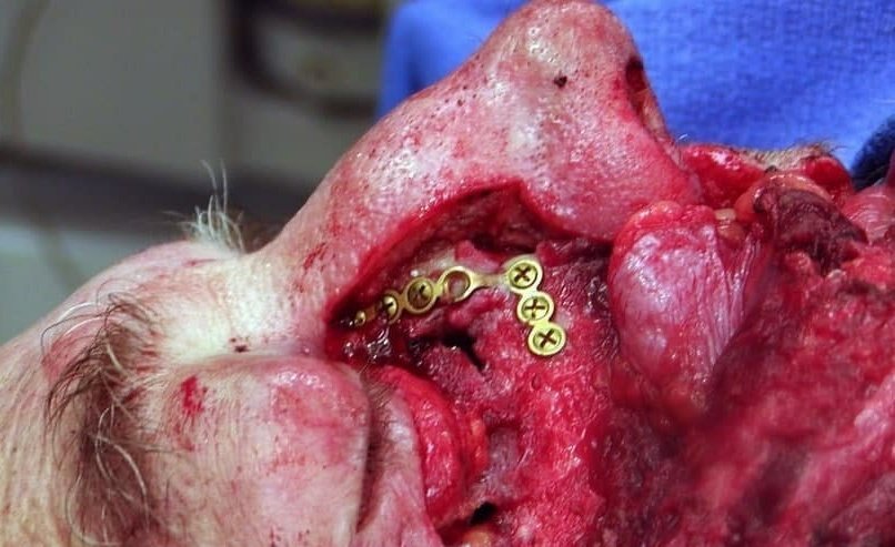 forensicmedic02's tweet photo. Malign bir tümörün çıkarılmasından sonra temporomandibular eklemin rekonstrüksiyonunun intraoperatif görünümü: https://t.co/mtpLuvXIFf