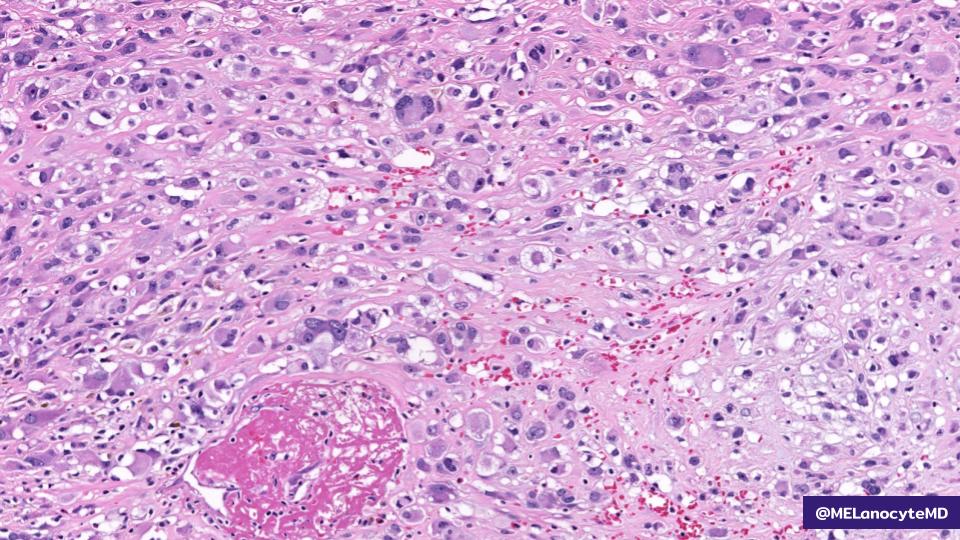 50♀️ with rapidly enlarging, painful forearm mass.

➡️ Differential diagnosis?
➡️ Confirmatory IHC?
➡️ Prognostic significance of this subtype?

🔎 WSI: kikoxp.com/posts/9763
💡 Answer: kikoxp.com/posts/9766

#bstpath #pathboards #Kiko25 <a href="/kiko4docs/">KiKo</a>