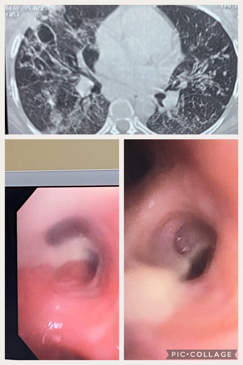 drasosa_'s tweet photo. Empezando con fuerza! Diabética con embolismo séptico y abundante pus dentro de ambos bronquios derecho e izquierdo. No tiene COVID. Vacunación completa https://t.co/7vFgFVrNj1