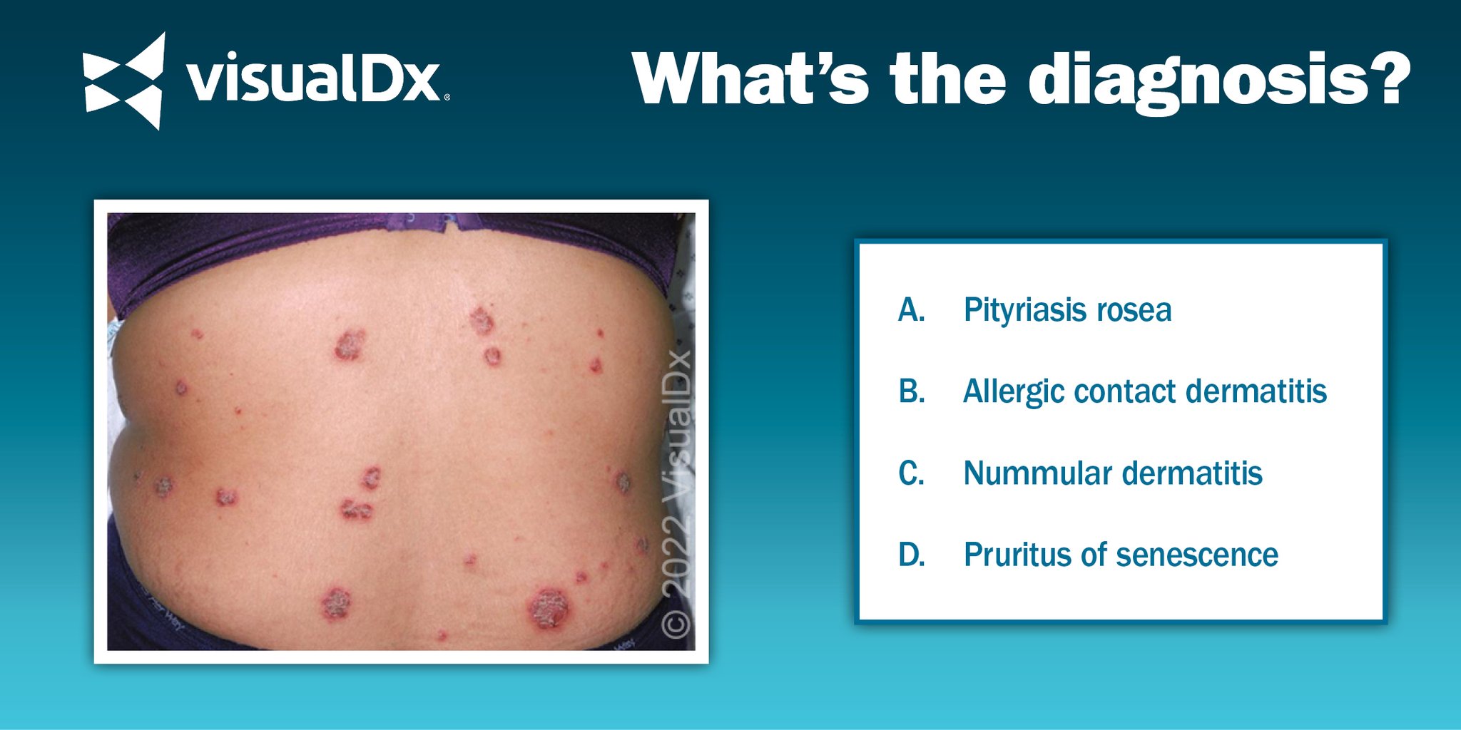VisualDx on Twitter "What’s the Dx? 55 yo woman w/pruritic rash that