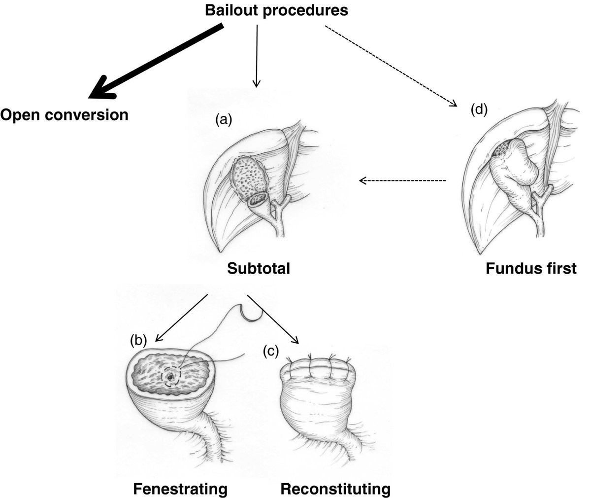 Bailout procedures for difficult laparoscopic cholecystectomy in acute cholecystitis by Tokyo guidelines! 👁🔪💥👇 #SoMe4Surgery #MedTwitter <a href="/pferrada1/">Paula Ferrada MD FACS FCCM MAMSE</a> <a href="/SWexner/">Steven D Wexner MD, PhD</a> <a href="/juliomayol/">Julio Mayol</a> <a href="/drdevirgilio/">Christian de Virgilio MD FACS</a> @DissanaikeMD <a href="/DrThawaba/">Abdullah Thawaba</a> <a href="/PipeCabreraV/">Dr Luis Felipe Cabrera Vargas MD FACS</a> <a href="/TopKniFe_B/">Bellal Joseph</a>