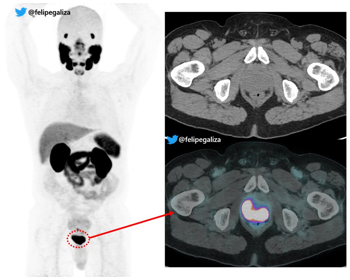 67yo PSA 47
DRE +

☢️MR PIRADS5
☣️PSMA-PET: very avid lesion (SUV 25)

➡️According to PRIMARY Trial the combination of these findings have 100% Sens + PPV for csPCa.

If the patient is motivated to treat surgically.
⚠️Is it necessary to biopsy before prostatectomy?