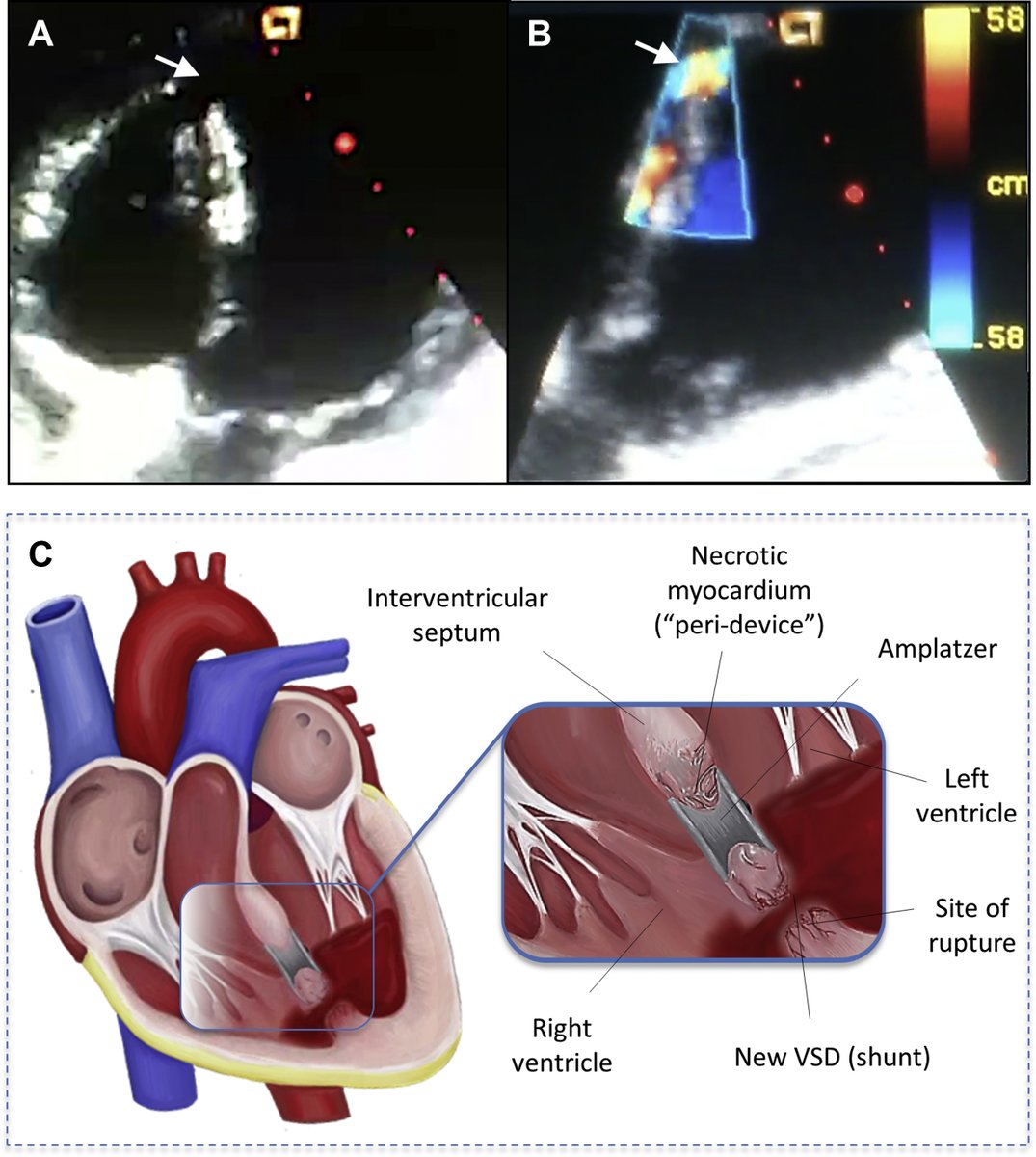 JACCJournals's tweet photo. #JACCCaseReports #WednesdayAnswer: Delayed surgery. Weakening of the surrounding infarcted myocardium creates “secondary septal defects” that hinders the late success of the VSR percutaneous closure procedure. Surgical repair is the gold standard of care. https://t.co/0WslBhH0LG https://t.co/ftwIvGdpQI