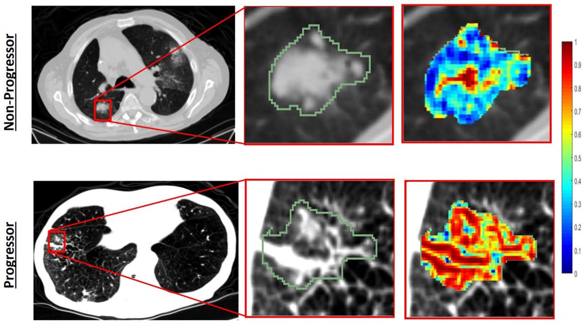 New #JITC article: Novel imaging biomarkers predict outcomes in stage III unresectable non-small cell lung cancer treated with chemoradiation and durvalumab bit.ly/3vHugGx @kjazieh @AmitGupta_83 @n8pennell @anantm