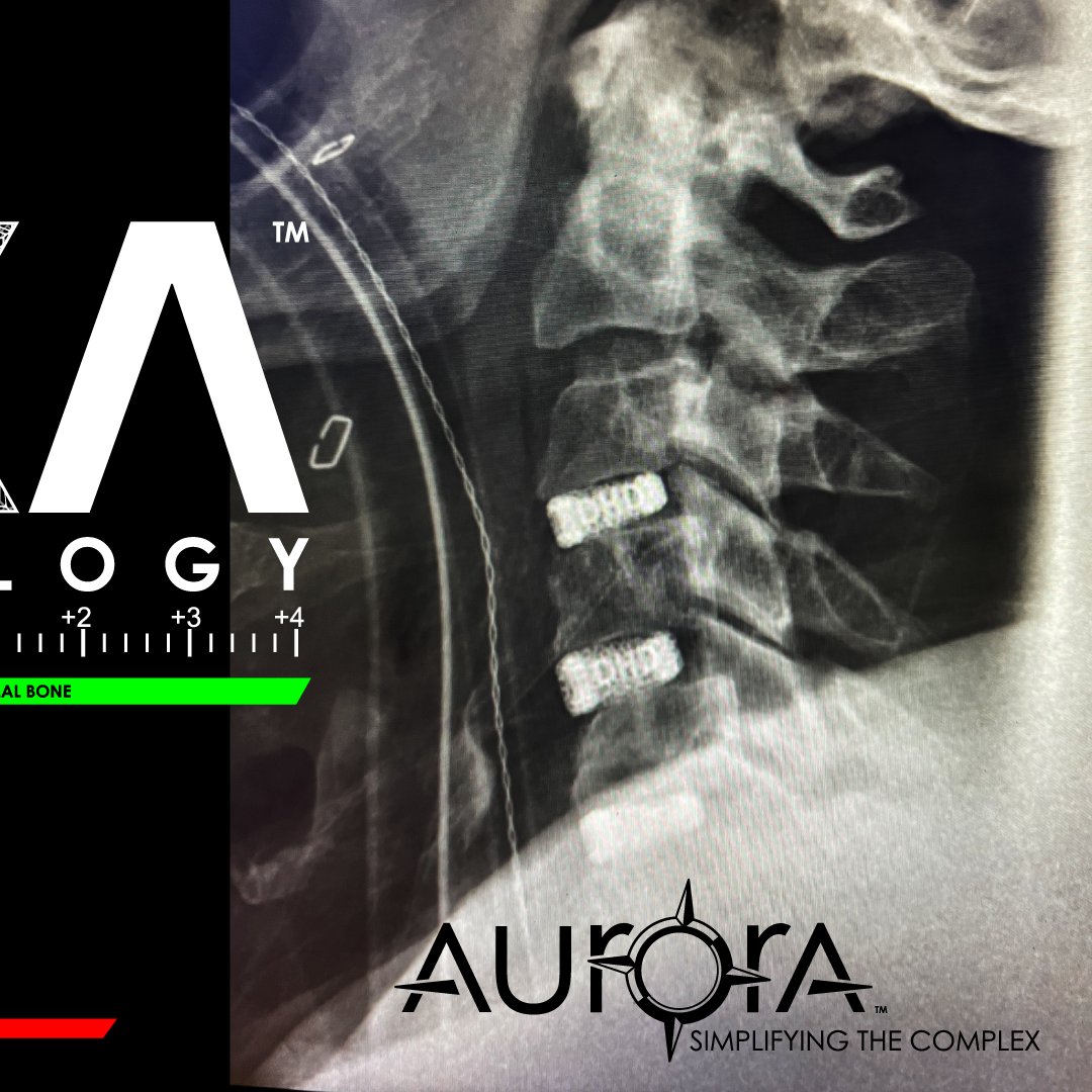 AuroraSpine's tweet photo. We care about your bone density! That's why we have developed the #DEXATechnology. Tell us... What's your T-score?
Learn more at:
https://t.co/ouleilCrPl
#BoneDensityMatters https://t.co/KFXTOHvyVq