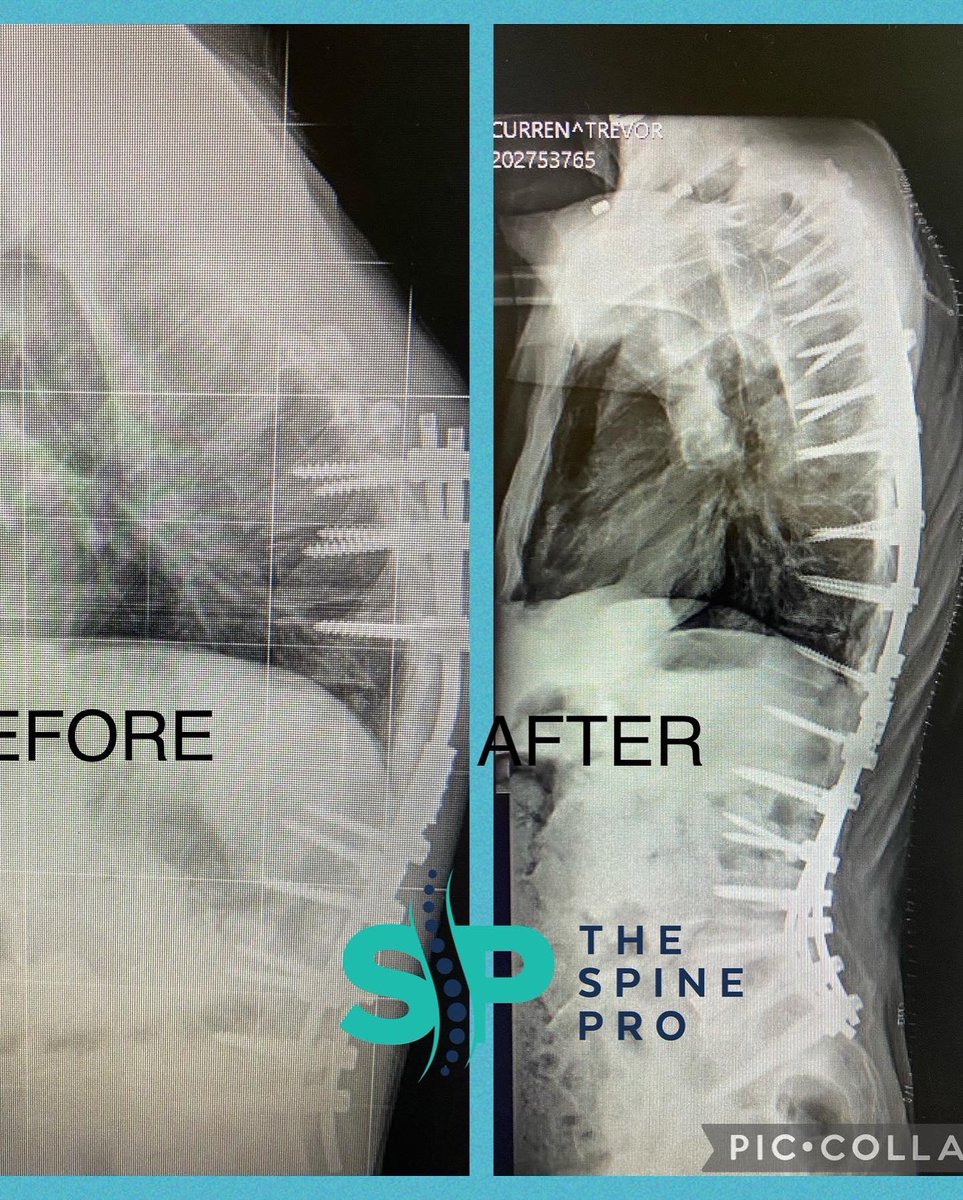 DrHMelamed's tweet photo. Pls Meet Trevor. He had to endure 4 bad spine surgeries that left him quite disabled & crooked. Here he is one day after 2 stage major revision reconstruction by me . #thespinepro #scoliosis #kyphosis #spine #spinesurgery #backpain https://t.co/8NkSCfJ73u
