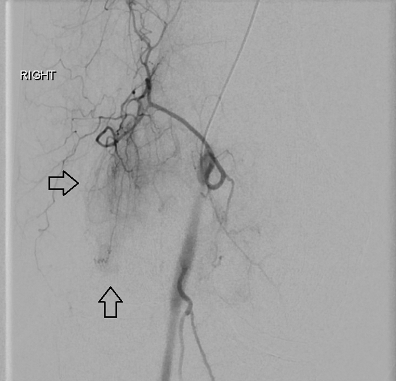 SemInterventRad's tweet photo. The purpose of this article by @AbinSajanMD is to describe the current literature on #genicular #artery #embolization and highlight the latest findings from a randomized controlled trial comparing GAE versus sham embolization.
📎 https://t.co/i3Nvp7OQpX
#musculoskeletal https://t.co/EXLBgmZSJK