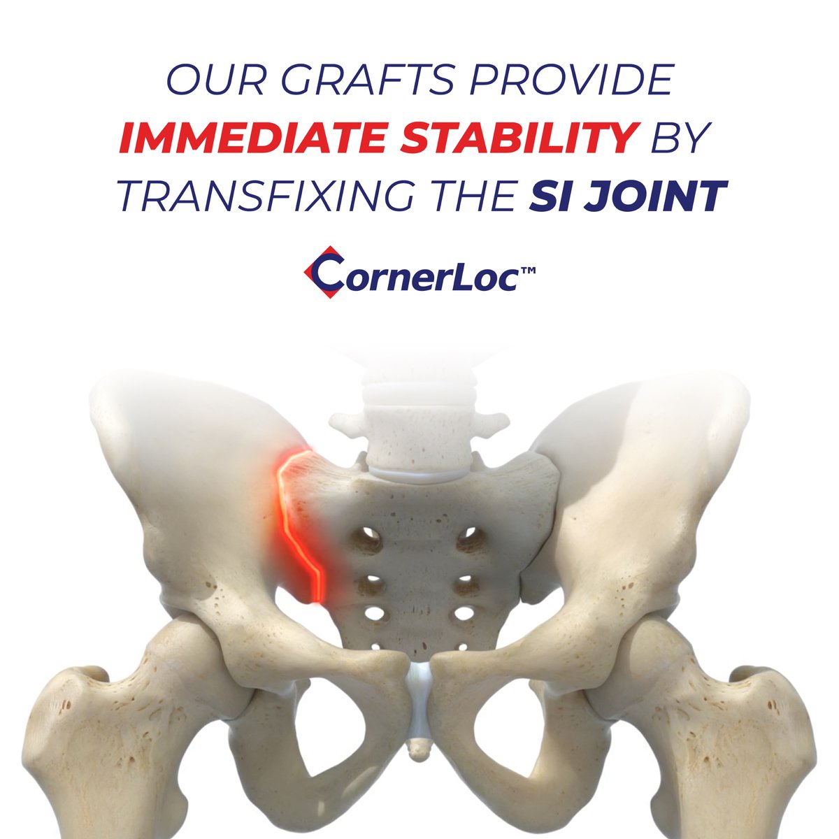 CornerLoc's tweet photo. Many needing a #SIjointfusion have been left without viable options in the past. With #CornerLoc, patients have a reliable option that has optimal stabilization & fusion potential. Learn more about the CornerLoc system here: https://t.co/KpbVzOibjk
#sijoint #sijointdsyfunction https://t.co/BZFnHZFDgF