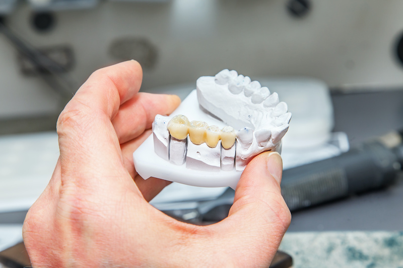 BlueOceanDDS's tweet image. The procedure for making a #FixedBridge is essentially the same as having a #DentalCrown made. However, a fixed #bridge involves at least two supporting #teeth. bit.ly/3vDuCxX