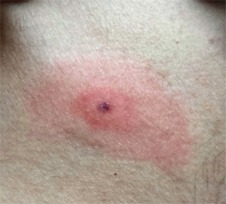 Editors@VJEM (@editorsvjem) on Twitter photo Early localized Lyme Disease. Come see what our authors <a href="/CrozerEM/">Crozer EM Residency</a> saw to make their diagnosis. <a href="/ELS_Emerg_Med/">Emergency Medicine</a> #EMbound #emergencymedicine #dermatology
sciencedirect.com/science/articl… Early localized Lyme Disease. Come see what our authors <a href="/CrozerEM/">Crozer EM Residency</a> saw to make their diagnosis. <a href="/ELS_Emerg_Med/">Emergency Medicine</a> #EMbound #emergencymedicine #dermatology
sciencedirect.com/science/articl…