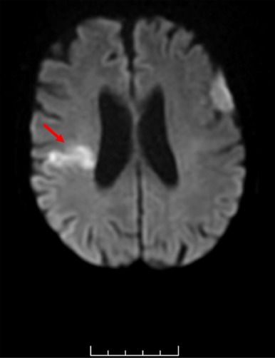 Editors@VJEM (@editorsvjem) on Twitter photo A case of stroke and STEMI: Which came first?
Come see what our authors <a href="/AndrewEyreMD/">Andrew Eyre</a> at <a href="/DrexelEmergency/">Drexel Emergency Med</a> <a href="/DrexelMedicine/">Drexel University College of Medicine</a> diagnosed and what happened to their patient. #Cardiology #emergencymedicine #embound <a href="/ELS_Emerg_Med/">Emergency Medicine</a>
sciencedirect.com/science/articl… A case of stroke and STEMI: Which came first?
Come see what our authors <a href="/AndrewEyreMD/">Andrew Eyre</a> at <a href="/DrexelEmergency/">Drexel Emergency Med</a> <a href="/DrexelMedicine/">Drexel University College of Medicine</a> diagnosed and what happened to their patient. #Cardiology #emergencymedicine #embound <a href="/ELS_Emerg_Med/">Emergency Medicine</a>
sciencedirect.com/science/articl…