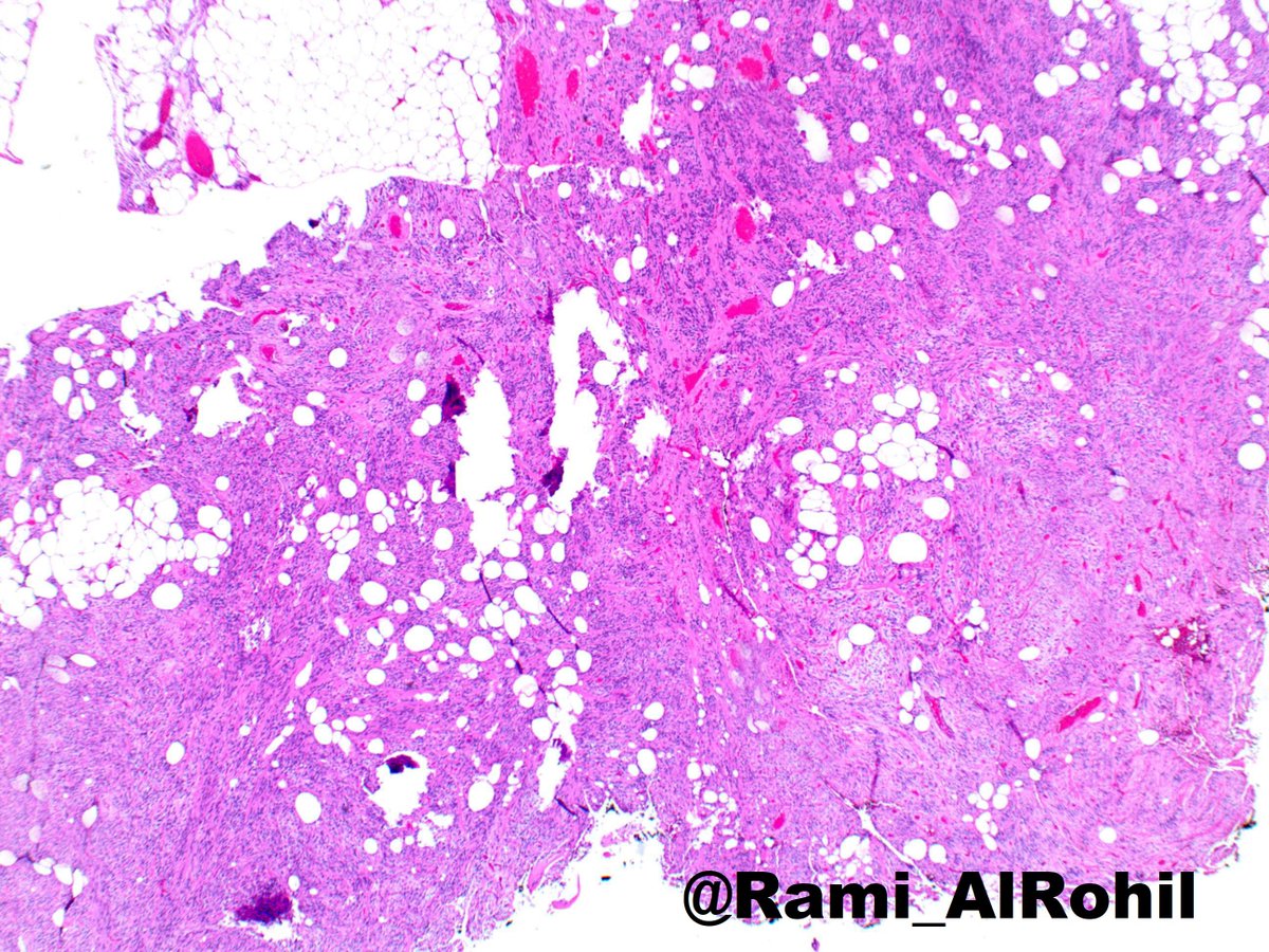 Rami_AlRohil's tweet photo. Spindle cell lipoma:painless subcutaneous mass,usually <5 cm &amp; on posterior neck/upper back🔬Bland/monotonous spindle cells with variable amount of adipocytes, “ropy” bright eosinophilic collagen bundles in a myxoid stroma &amp; scattered mast cells #dermpath #dermatology #pathology https://t.co/G9TlXYDSwi
