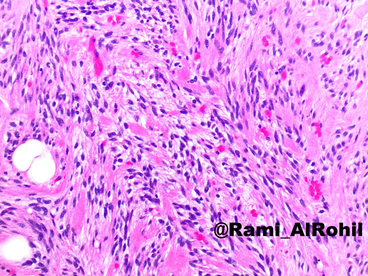 Rami_AlRohil's tweet photo. Spindle cell lipoma:painless subcutaneous mass,usually <5 cm &amp; on posterior neck/upper back🔬Bland/monotonous spindle cells with variable amount of adipocytes, “ropy” bright eosinophilic collagen bundles in a myxoid stroma &amp; scattered mast cells #dermpath #dermatology #pathology https://t.co/G9TlXYDSwi