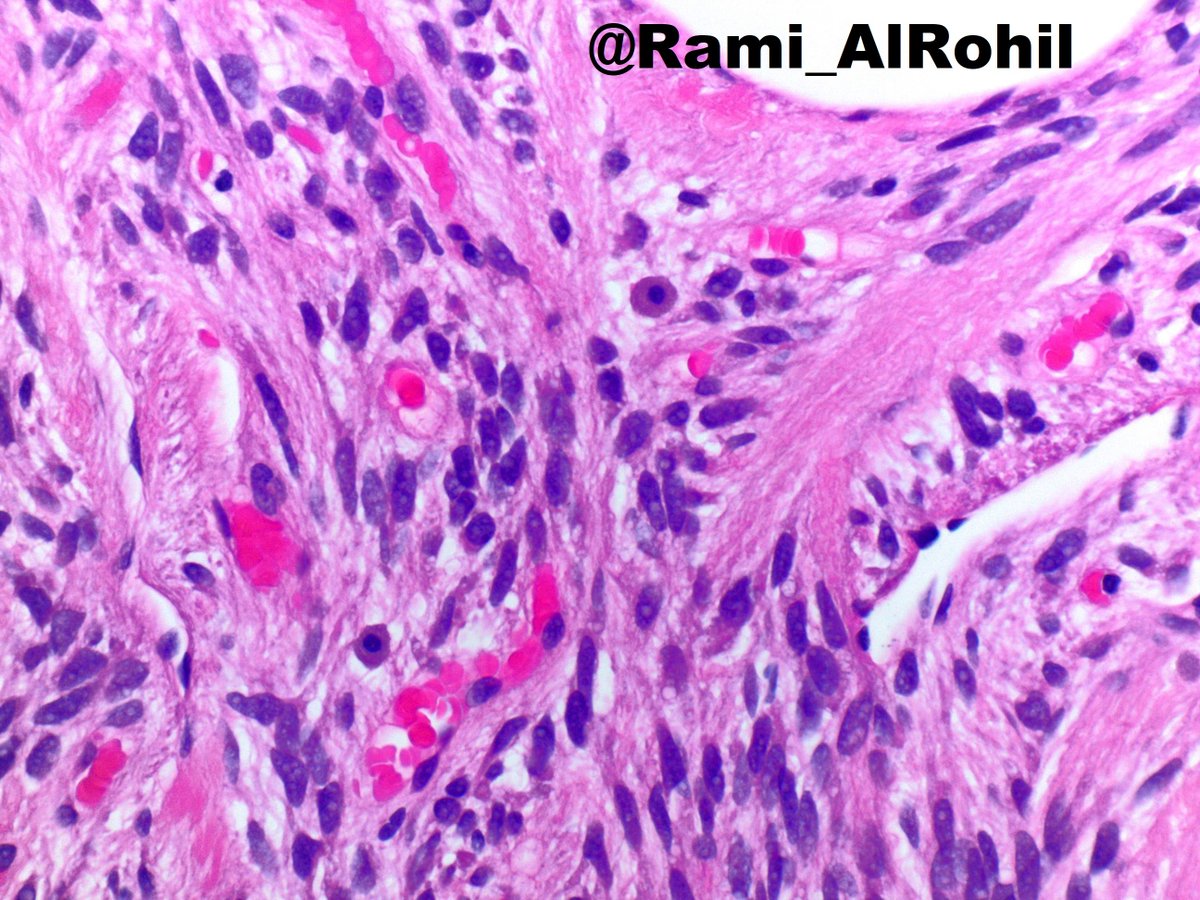 Rami_AlRohil's tweet photo. Spindle cell lipoma:painless subcutaneous mass,usually <5 cm &amp; on posterior neck/upper back🔬Bland/monotonous spindle cells with variable amount of adipocytes, “ropy” bright eosinophilic collagen bundles in a myxoid stroma &amp; scattered mast cells #dermpath #dermatology #pathology https://t.co/G9TlXYDSwi