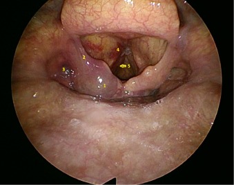 Editors@VJEM (@editorsvjem) on Twitter photo Laryngeal Hematoma following blunt trauma
<a href="/SEMI_India/">Society for Emergency Medicine India</a> <a href="/ELS_Emerg_Med/">Emergency Medicine</a> #ENT #emergencymedicine
sciencedirect.com/science/articl… Laryngeal Hematoma following blunt trauma
<a href="/SEMI_India/">Society for Emergency Medicine India</a> <a href="/ELS_Emerg_Med/">Emergency Medicine</a> #ENT #emergencymedicine
sciencedirect.com/science/articl…