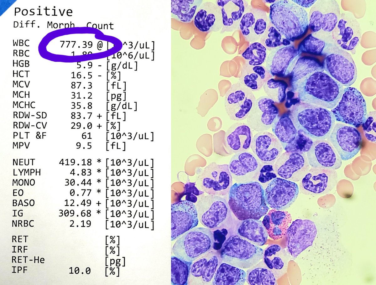 Josh_PetersonMD's tweet photo. Our patient hit the leukemia jackpot today 🎰 😬
Accelerated phase of CML on peripheral smear ⬇️
#hemepath
@KirillLyapichev @UTMB_Pathology 
@drfatimaiqbalk1 @PaulYoungMD1 @AWilhelmMD @lgbigham92 https://t.co/8UIpsQaEo7
