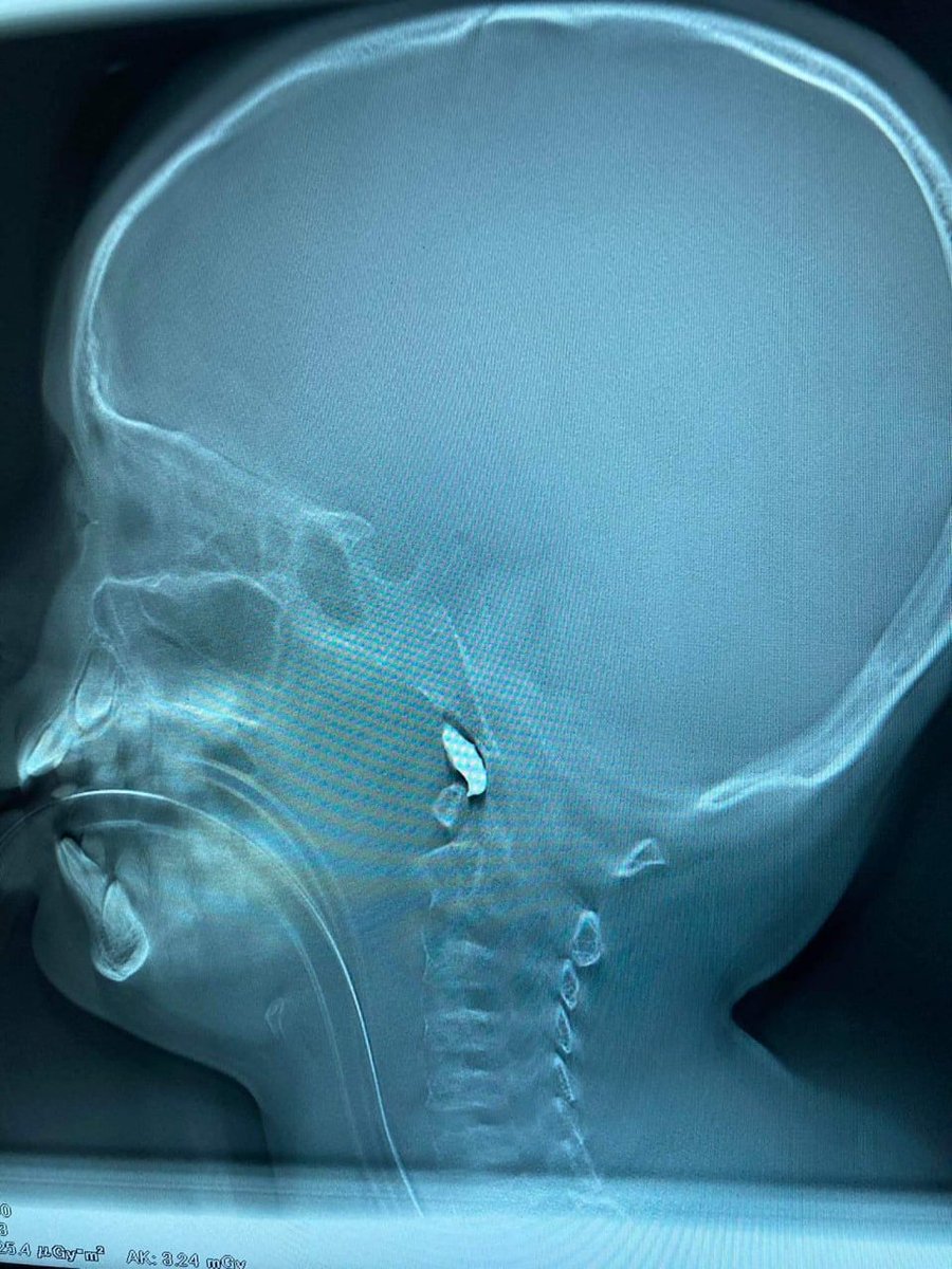 dkaleniuk's tweet photo. X-ray scan of a 10-year old boy from Kharkiv. When Russian bomb hit his home, shrapnel penetrated his head via cheekbone. Doctors now fighting for his life.  Just "drills" of the Russian soldiers. #ProtectUASky https://t.co/JGaFL1phtu