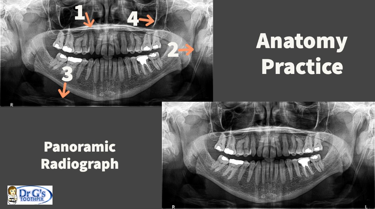 Answers for Anatomy Practice
1 = Floor of the nasal cavity
2 = Soft tissue of the ear / ear lobe
3 = Hyoid
4 = Zygomatic process of the maxilla