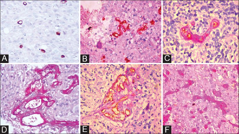 Glioma17's tweet photo. #Glioma [Original Article] Assessment of microvascular patterns and density in glioblastoma and their correlation with matrix metalloproteinase-9, p53, glial fibrillary acidic protein, and Ki-67
#glioblastoma #microvascular

https://t.co/CqRNhMfkKc https://t.co/eOL8PvQvx2