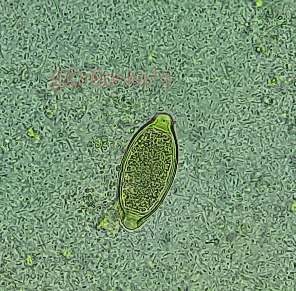 DrBonita16's tweet image. Hellow #pathtwitterfamily 
M always thankful to you for the beautiful cases and valuable opinions...I feel bad as I can't  post such cases...Here is one from whatever I get to see under my scope  @atman_ci @Venkateshgilly2 @pepeheffernan @DrGeeONE @kriyer68 @pembeoltulu