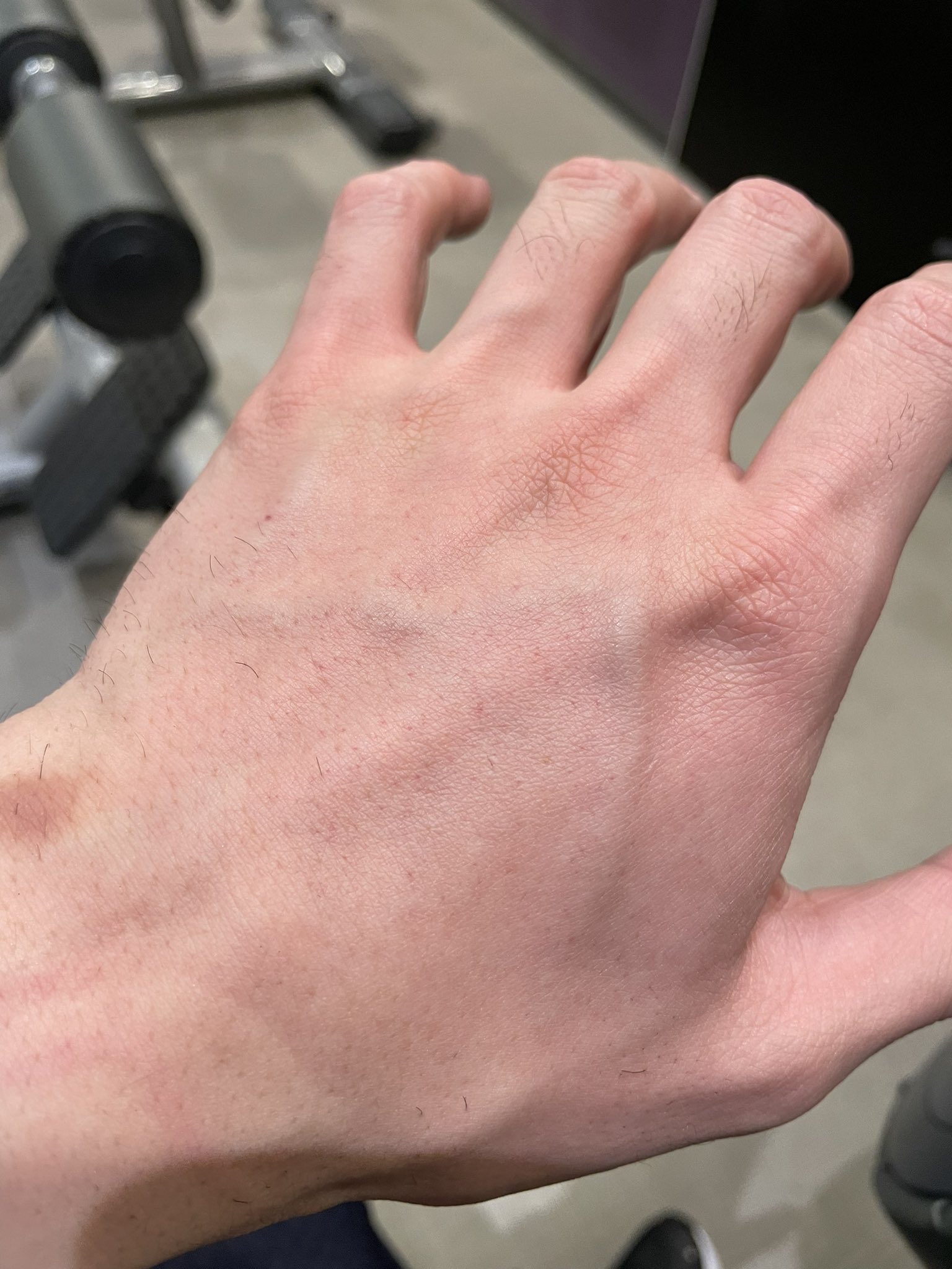 黄色い閃光 筋トレ垢 俺いつもデッドリフトやると手の甲ポツポツ斑点状の内出血するんだけどみんなもなるの デッドリフト T Co 6ypmfhnwii Twitter