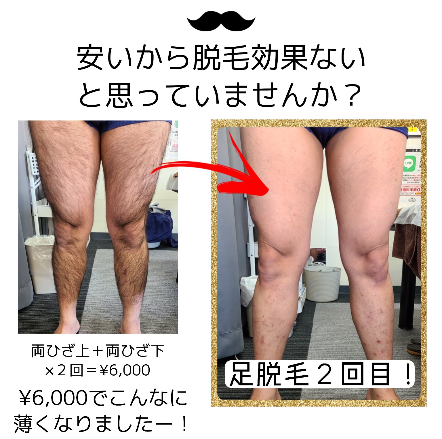 Twitter 上的 メンズ脱毛キガルモ宇都宮店 キガルモ宇都宮店 ビフォーアフター 安いだけじゃなく 脱毛効果もしっかりと実感できるのも自慢できるサロンです 脱毛 メンズ脱毛 男性脱毛 髭 全身脱毛 Vio 都度払い 美意識向上 ツルツル