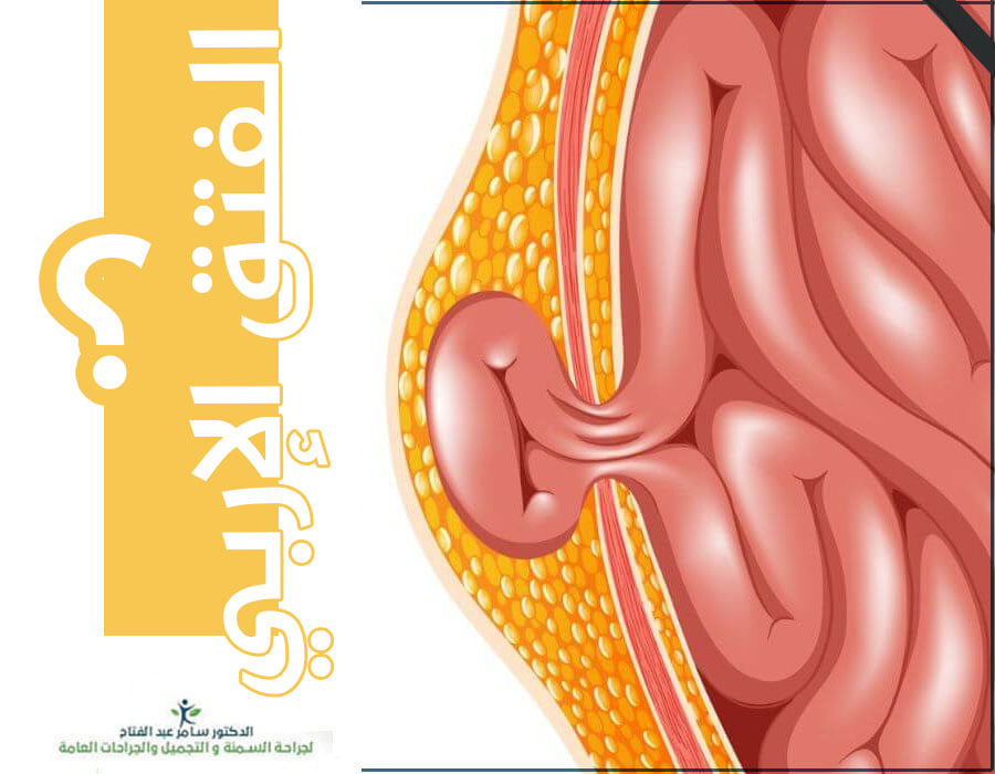 #الفتق هو عبارة عن خروج عضو أو جزء من مكان المخصص له من خلال جدار التجويف الذي يحتويه، يحدث الفتق أو التمزق عندما يندفع الجزء الداخلي من الجسم من خلال وجود ضعف في العضلات المحيطة أو أنسجة جدار
لأي تفاصيل او استشارات تواصلوا مباشرة مع:
#الدكتور_سامر_عبدالفتاح
00962790250308