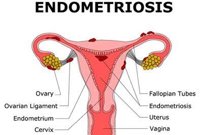 March is endometriosis awareness month. So what is endometriosis? Who does it affect? How is it treated? Are there ways of preventing it? [A Thread]