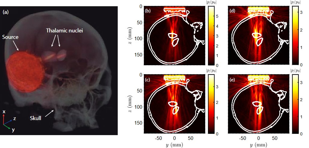 UMIL researchers have recently published a paper in #Ultrasound in Medicine and Biology, a numerical study of the performance of #acousticholograms focusing at the thalamic nuclei through the temporal bone window.
doi.org/10.1016/j.ultr…