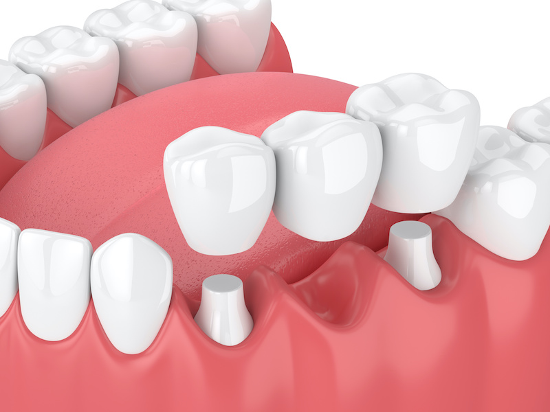 BlueOceanDDS's tweet image. With a #FixedBridge, the #teeth on both sides of the #MissingTooth must provide support. #DentalCare bit.ly/3vDuCxX