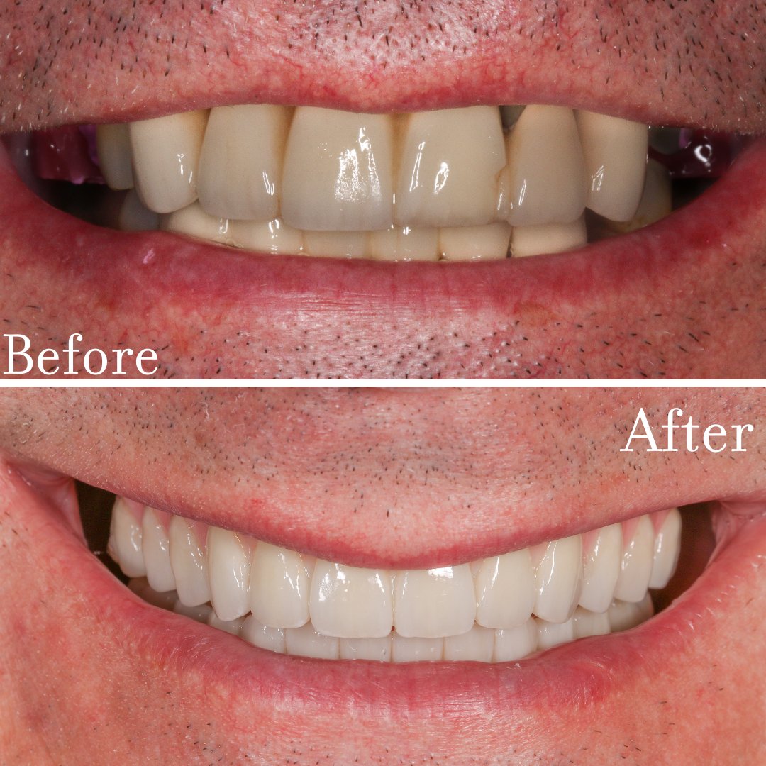 UADChicago's tweet photo. Check out this smile makeover! #uad #yoursignaturesmile #dentistry 
https://t.co/DYhpNmGcy6 https://t.co/t1lxjWOMYW