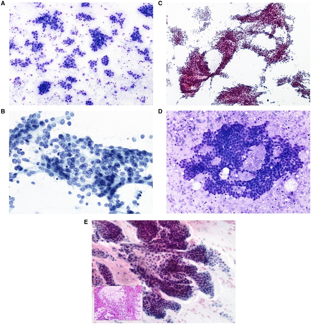 CancerCytopath's tweet image. New from Paul E. Wakely MD (@OSUWexMed) | Salivary duct carcinoma: A report of 70 FNA cases and review of the literature ow.ly/4n1i50IcW1B #CytoPath #FNAPath #MilanSystem