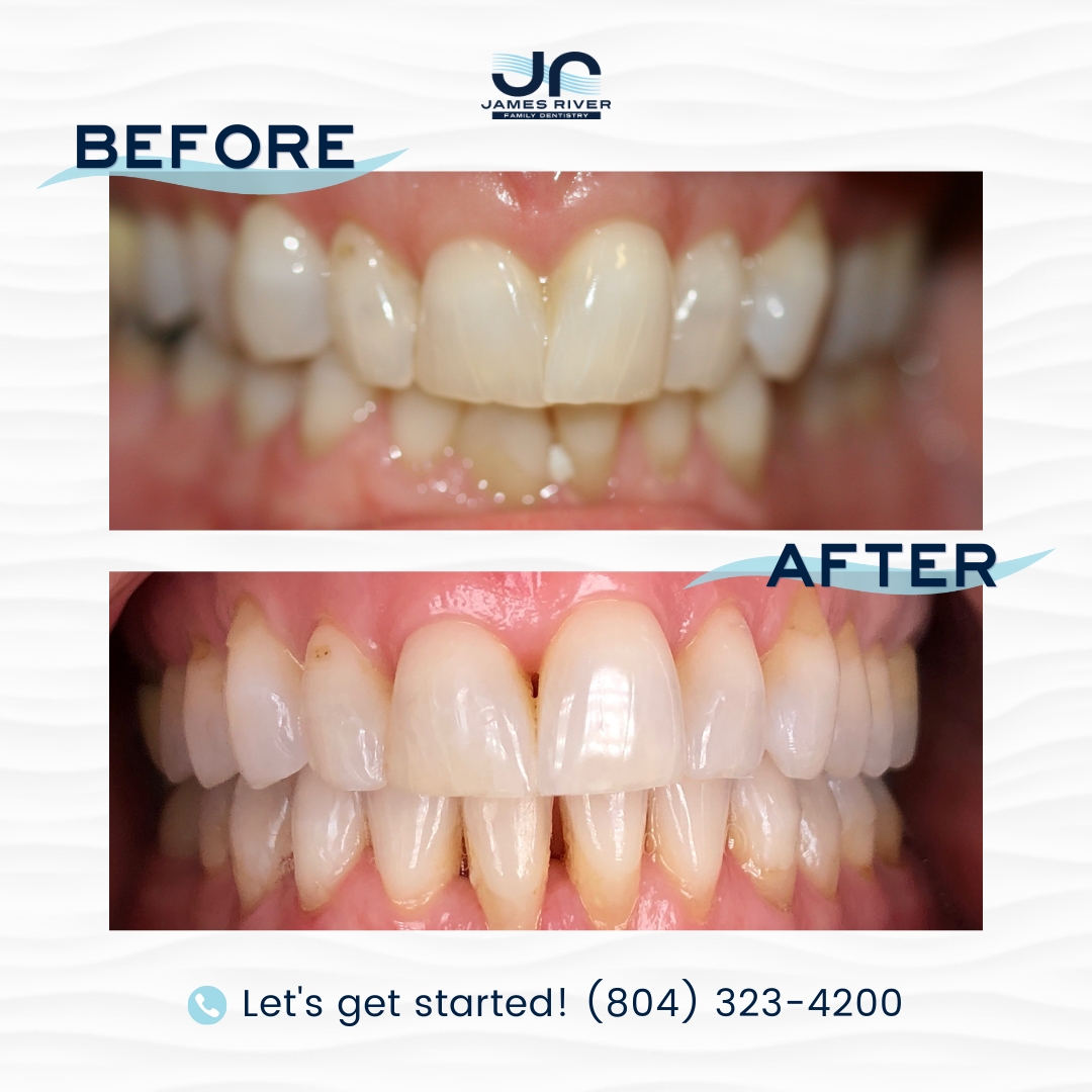 jrfamilydentist's tweet photo. WOW! ๐ And that, folks, is the power of Invisalignยฎ! ๐๐ This patient came to James River Family Dentistry seeking an improvement to their smile with Invisalign. The end result? A stunning new smile and a happy patient! ๐โจ
#JRFD #Invisalign #InvisalignProvider #NewSmile https://t.co/RAWtoig3wJ