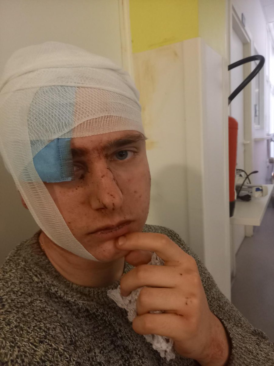 PF_Benedetti's tweet photo. Mon neveu J-Claude, 16 ans, a été atteint d'un tir de flash ball à Aiacciu. Il a reçu des coups de pieds dans la tête et à la gorge.
Le nouveau @Prefet2A nous montre sa conception du dialogue: En faisant frapper des manifestants ou non manifestants et en mettant des vies en jeu. https://t.co/MhJbJxyE9D