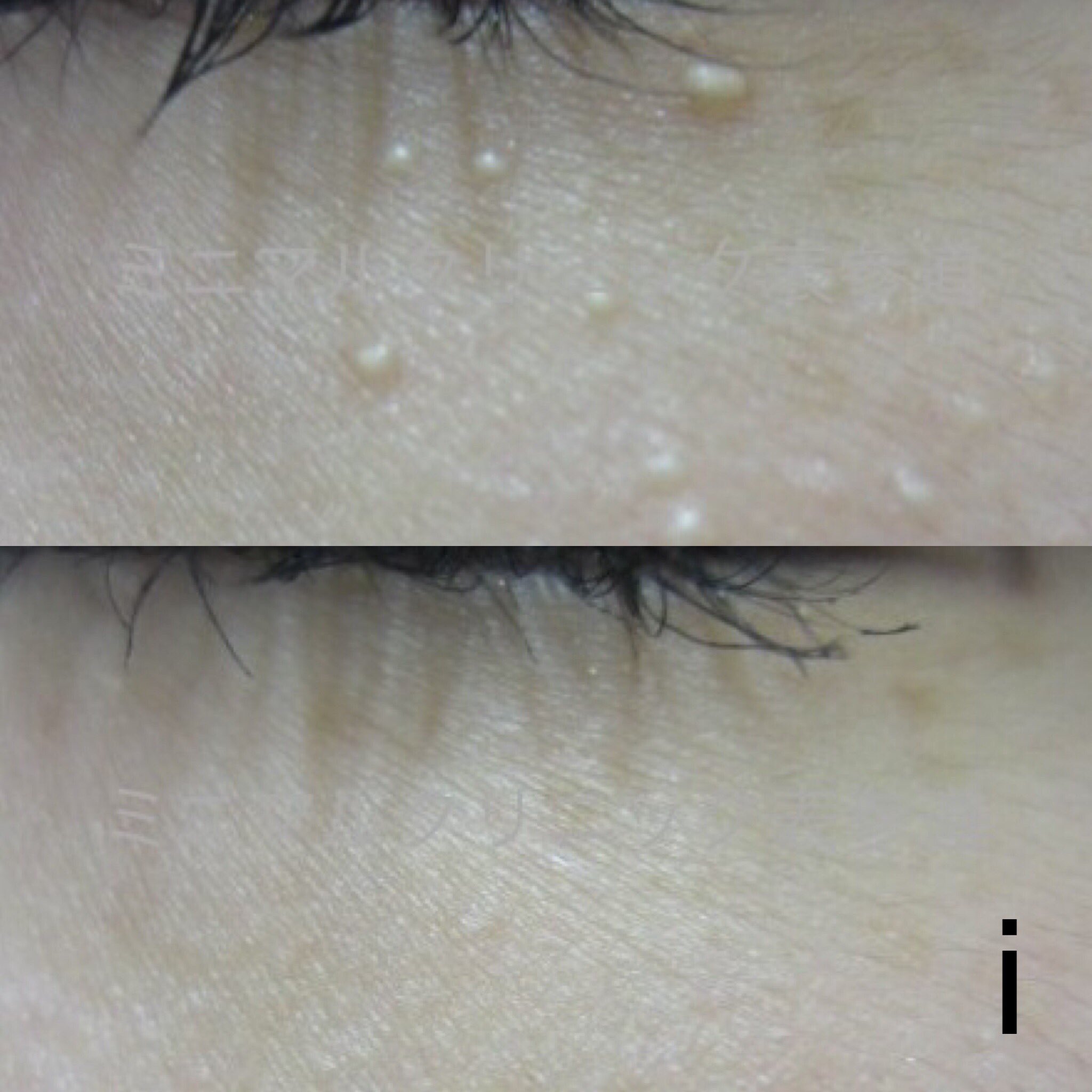 汗管腫 Twitter Search Twitter