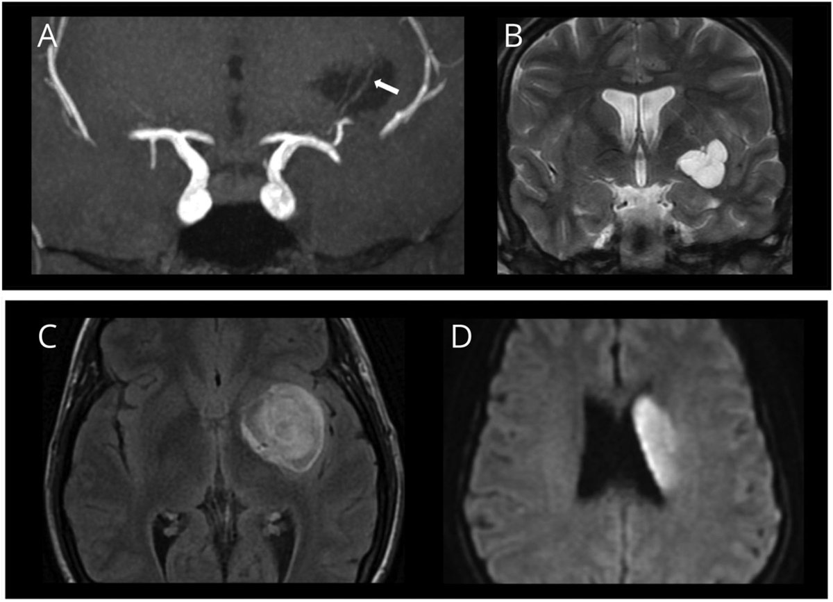 A 33-year-old woman was admitted with right side hemiplegia after head trauma. Brain MRI revealed an acute ischemic stroke in the left lenticulostriate territory and a parenchymal hematoma. Learn more in the latest Teaching #NeuroImage: bit.ly/3pBT0vP #NeurologyRF