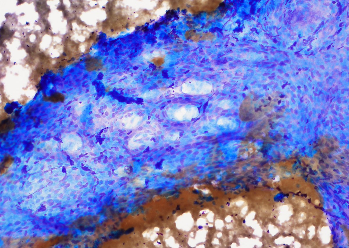 NHardy_path's tweet photo. Glomus tumor – FNA of one of many reportedly painful foot nodules shows uniform round cells lining branching capillary-sized vessels. Cytology on these sometimes just shows round cell clusters, but this case had nice architecture on smears. SMA+ cute pericytic neoplasm. https://t.co/w8XPg9Xa1h