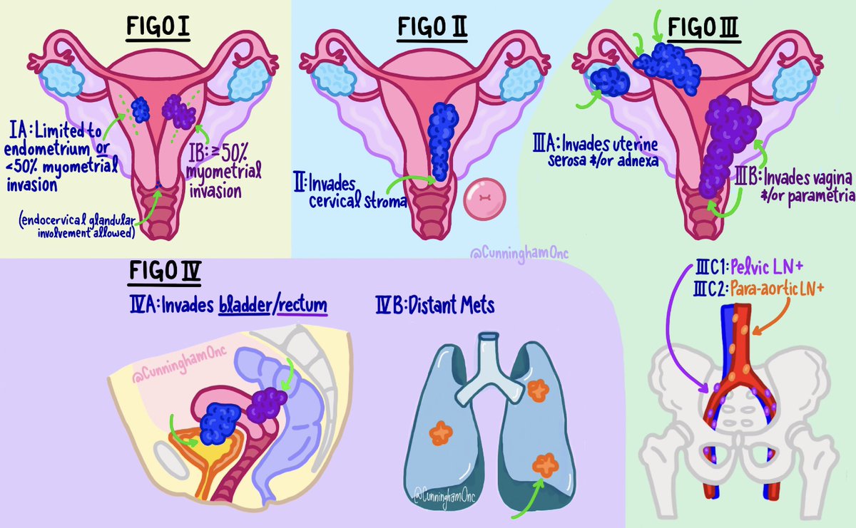 Simplified illustration for #endometrial #cancer staging
 #meded #radonc #gynonc #gyncsm #roedu #obgyn #oncology