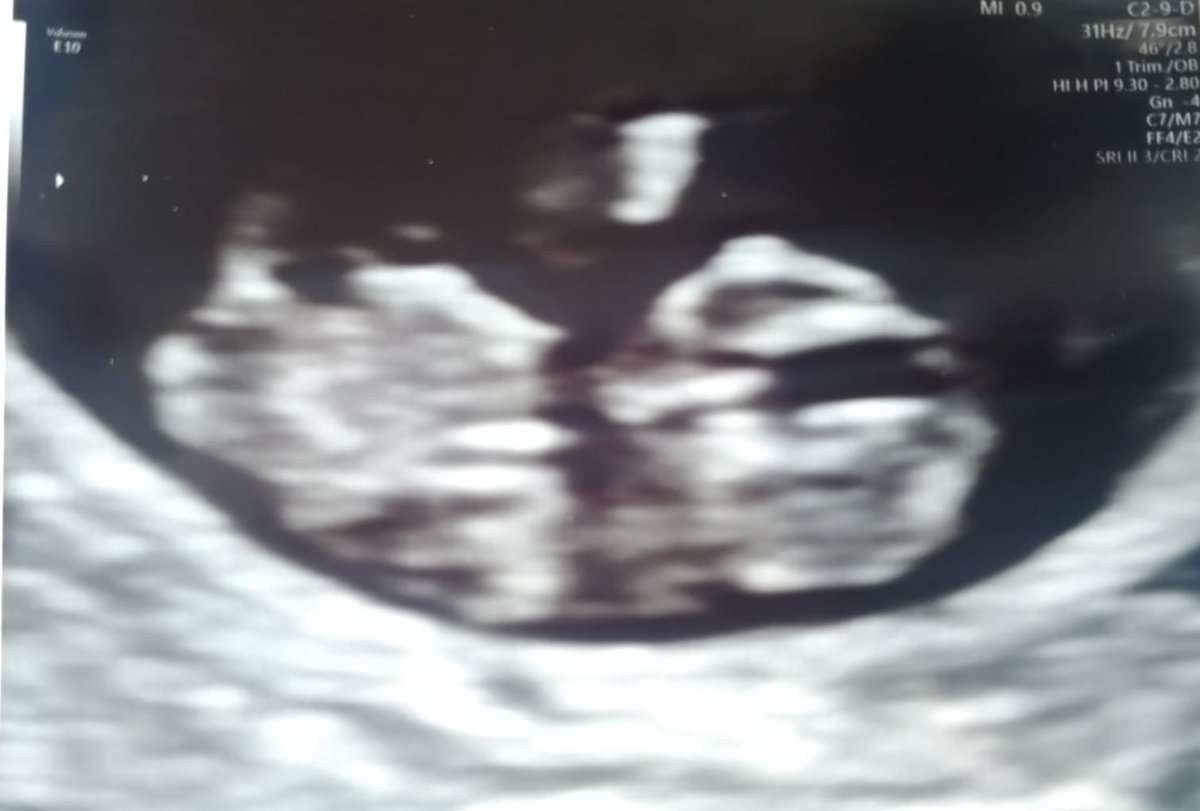sinister_pixie's tweet photo. Hey twitter fam let me introduce baby pixie ouf first scan of him/her I had been nervous all day but after seeing my child I can honestly say I've never loved something so much in my life so yeah I can't wait to meet baby pixie for real but till then #scan #babypixie #happy https://t.co/IJkubqUqEh