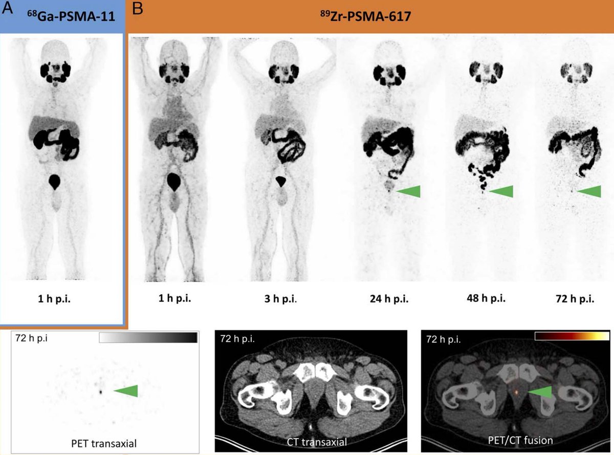 CalaisJeremie's tweet photo. Nice illustration of (very) late PSMA PET imaging at +3 days with Zirconium-89: Digestive activity and late tracer retention in a local recurrence focus of prostate cancer after surgery. By Florian Rosar and Samer Ezziddin @Prof_Ezziddin #PSMA #theranostics #prostatecancer #PETCT https://t.co/KC6OtU1ixg