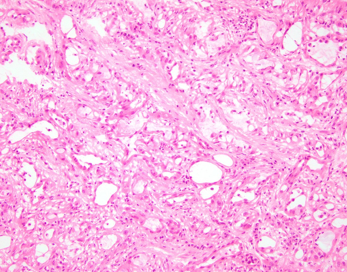 Andres Martin Acosta (Andy) (@andres_m_acosta) on Twitter photo Frozen section/intraoperative evaluation of an incidentally discovered paratesticular mass. Relevant PMID 👉19543245 by <a href="/slusagar/">Ankur Sangoi</a> . #gupath #pathology Frozen section/intraoperative evaluation of an incidentally discovered paratesticular mass. Relevant PMID 👉19543245 by <a href="/slusagar/">Ankur Sangoi</a> . #gupath #pathology