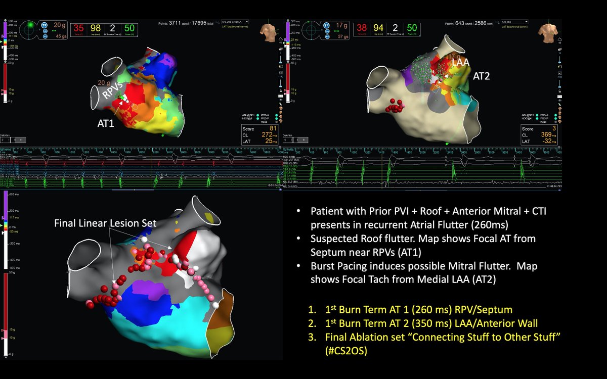 Unusual redo because the previous ablation was intact (PVI, roof, anterior mitral line) yet 2 distinct ATs came from areas near the previous ablation🤔. Termination (x2) was quick, but we decided on linear ablation #CS2OS. Thanks @ryancolemaps @TJHeartFellows @AbbottCardio