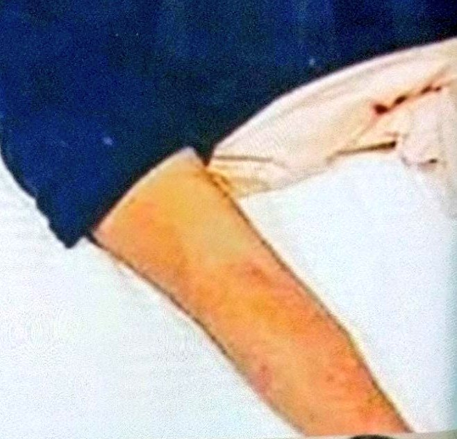 Justice4SSR_'s tweet photo. - Bruises on body

CBI Stop Dragging SSR Case https://t.co/bXXZ9AgeBM