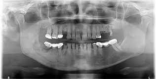 🔹American Association of Oral and Maxillofacial Surgeons’ Position Paper on Medication-Related Osteonecrosis of the Jaw, by <a href="/aaoms/">AAOMS - Oral and Maxillofacial Surgeons</a> journal

🔸joms.org/article/S0278-… #MaxiloLaPaz