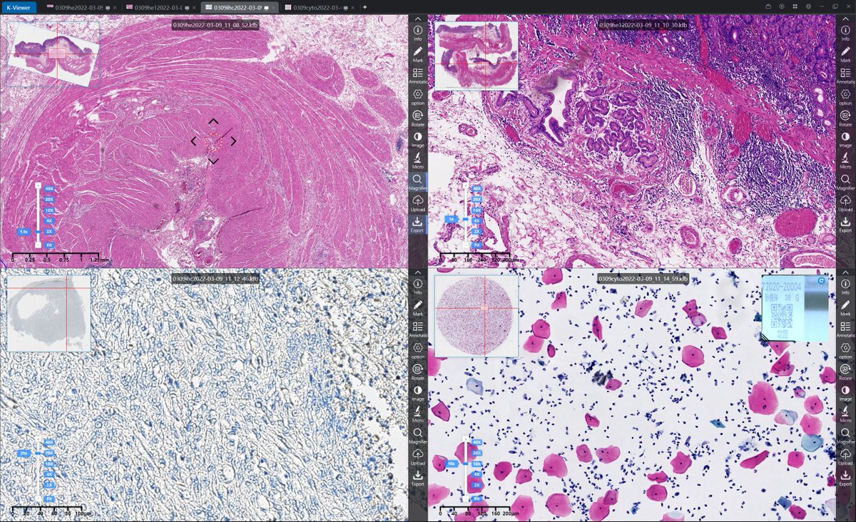 KFBIO1's tweet photo. However, telepathology has become a daily practice for many pathology labs in the past decade, as the scanners, IT cloud service, 5G tech has made it a reality.
#telepathology
#digitalpathology
#pathologyimage https://t.co/z5U8dH3ABo