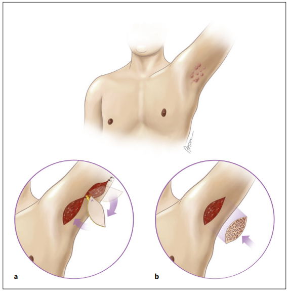 DermaKarger's tweet photo. Read our new #OpenAccess article: Outcome Comparison of Different Reconstructive Approaches for Axillary Defects Secondary to Radical Excision of Hidradenitis Suppurativa.
✍️Vlad Tereshenko et al.
���https://t.co/AKH7K2QTju
---
#Skin #Dermatology #OA https://t.co/sGJzRtYTqG