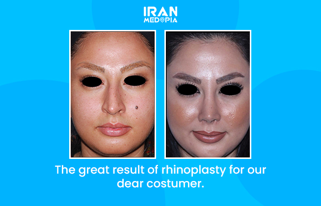iranmedopia's tweet image. #nosejob #postoperation #rhinoplasty #nosejobeiniran