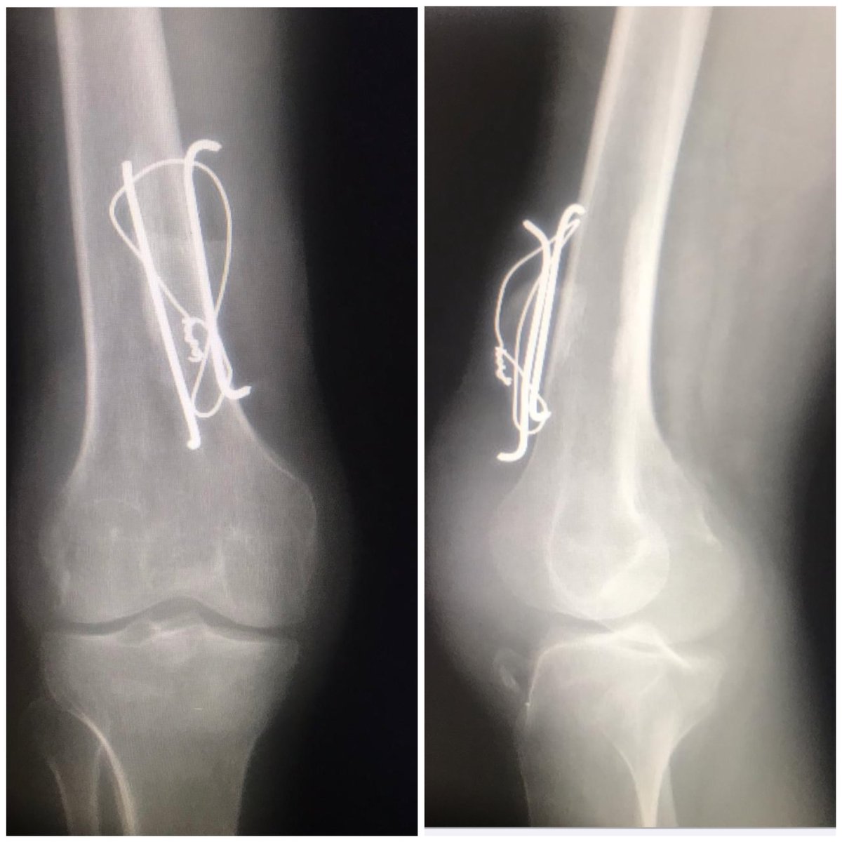 ayedshahran's tweet photo. 🔹Neglected injury of patellar tendon after open fx patella
🔹7 months later presentation with retracted patella
🔹gradual descent of patella with ilizarove
🔹contralateral bone patellar bone graft to reconstruct patellar tendon
#orthotwitter
#limb_reconstruction https://t.co/AF8RbrX6pl