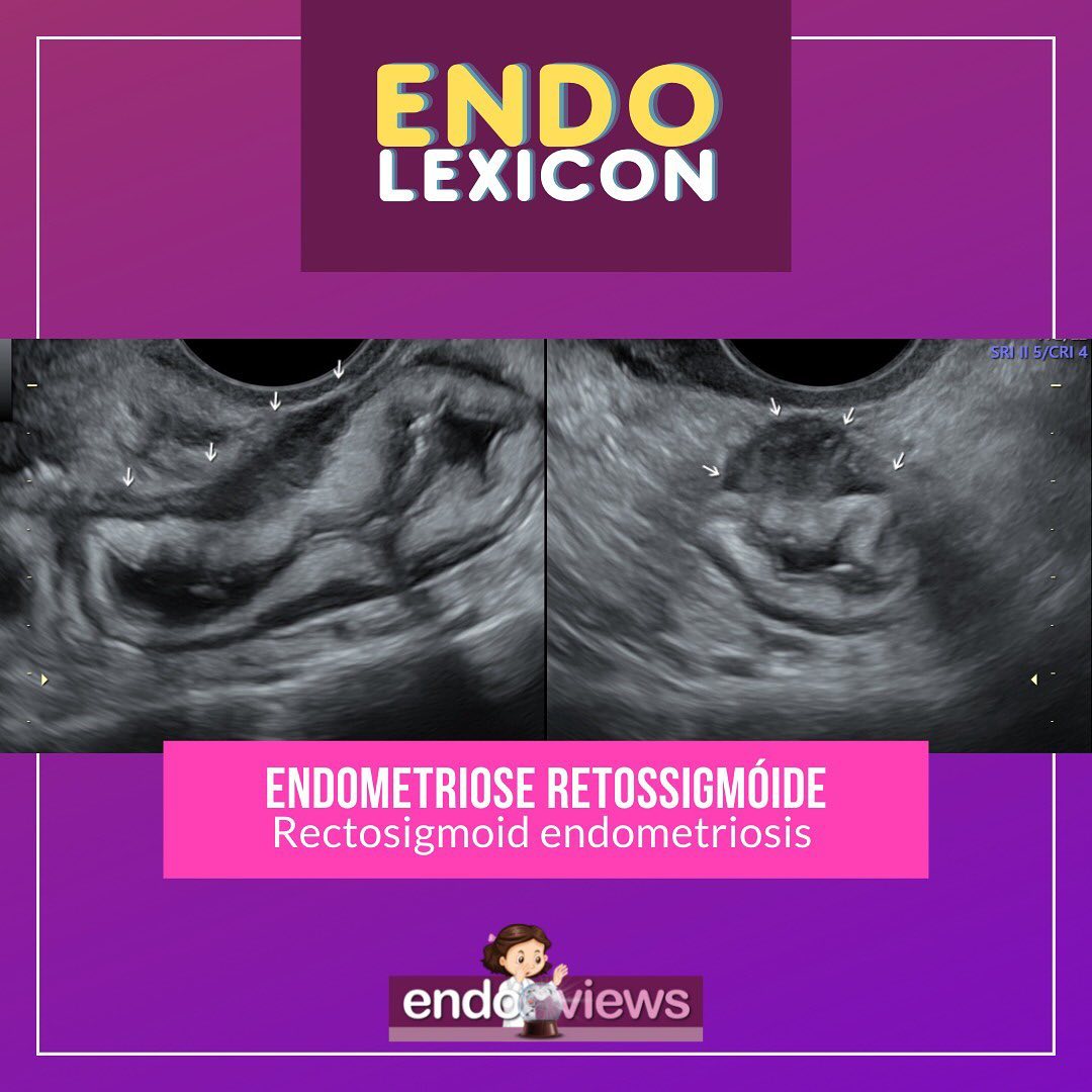 endoviews's tweet photo. Como descrever lesões intestinais no USTV
How to report intestinal endometriosis at TVS
📲 https://t.co/HuihegpakD
🔮Endoviews. O seu banco de imagem em endometriose.
#endometriose #endometriosis #endometrioseintestinal #intestinalendometriosis https://t.co/kvtEcC458t
